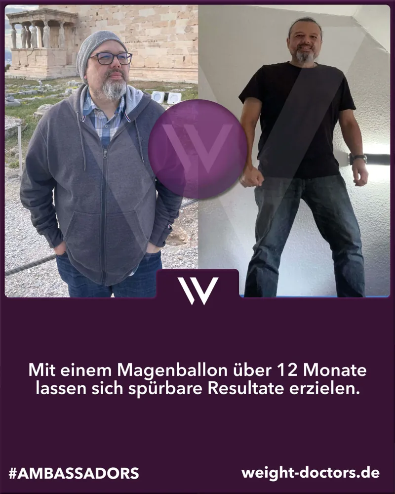 Weight Doctors® Vorher-Nachher: Patient vor und nach zwölf Mönet mit em Weight Doctors® MAGENBALLON