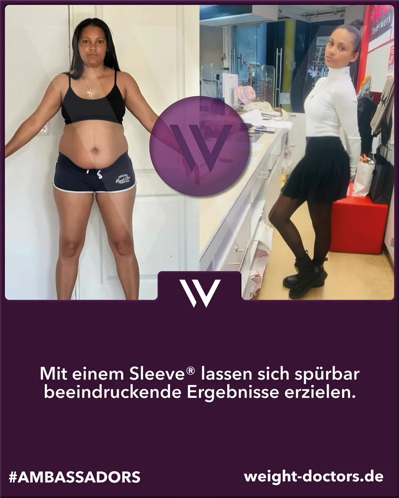 Weight Doctors® Vorher-Nachher: Patientin vor und nach ihrem Weight Doctors SLEEVE®