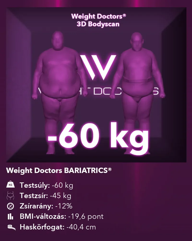 Weight Doctors® 3D Bodyscan előtte és utána: mínusz 60 kg a Weight Doctors BARIATRICS® segítségével, testzsír mínusz 45 kg