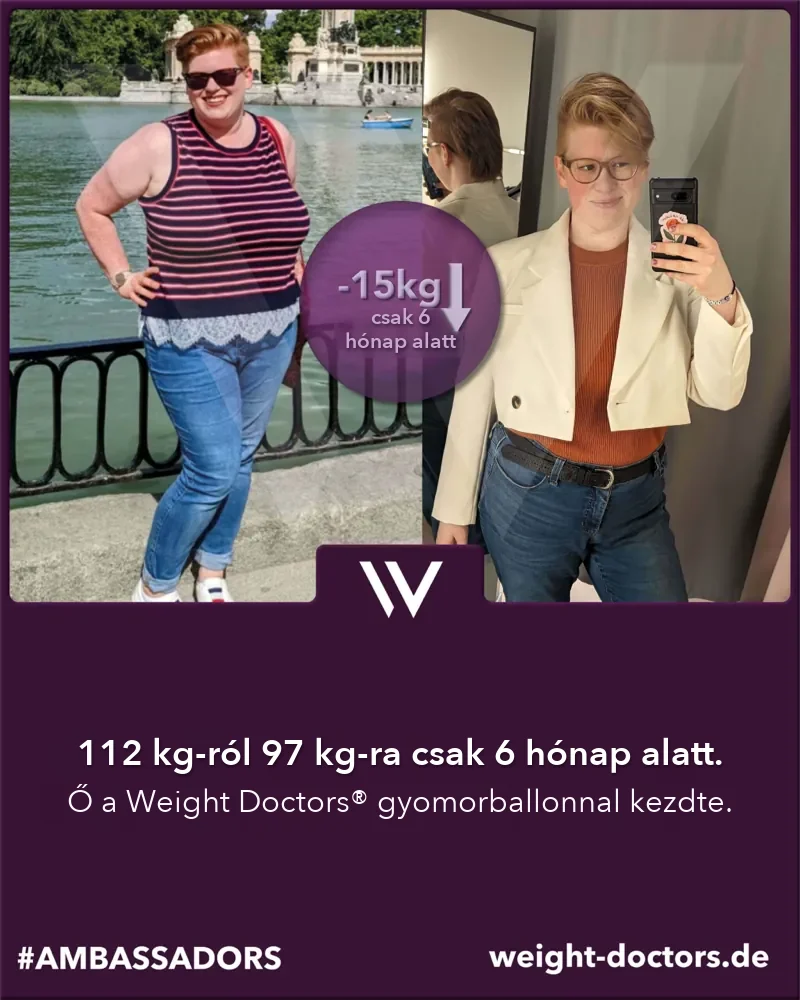 Weight Doctors® előtte-utána: női páciens 112 kg-ról 97 kg-ra hat hónap alatt, a Weight Doctors® GYOMORBALLON segítségével