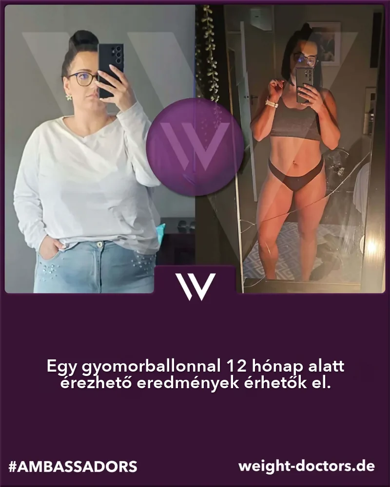 Weight Doctors® előtte-utána: női páciens előtte és tizenkét hónappal később, a Weight Doctors® GYOMORBALLON segítségével