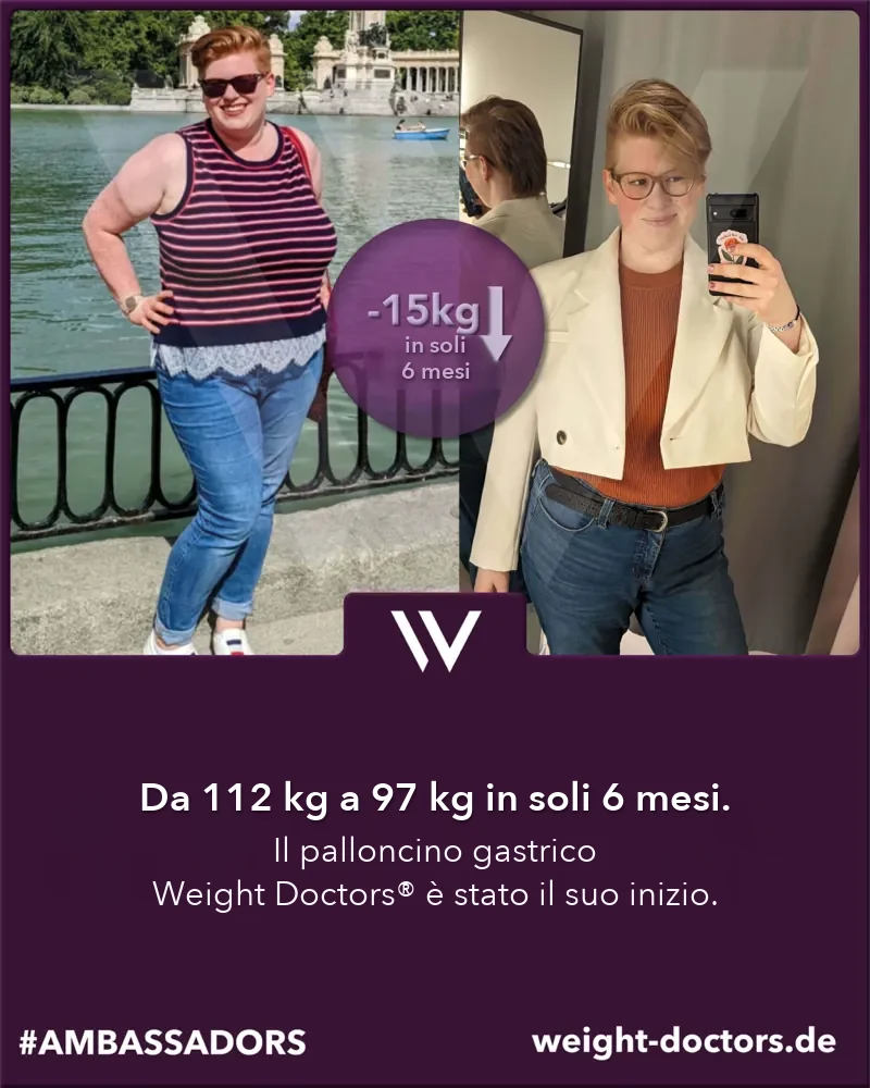 Weight Doctors® prima e dopo: paziente da 112 kg a 97 kg in sei mesi, con Weight Doctors® PALLONCINO GASTRICO