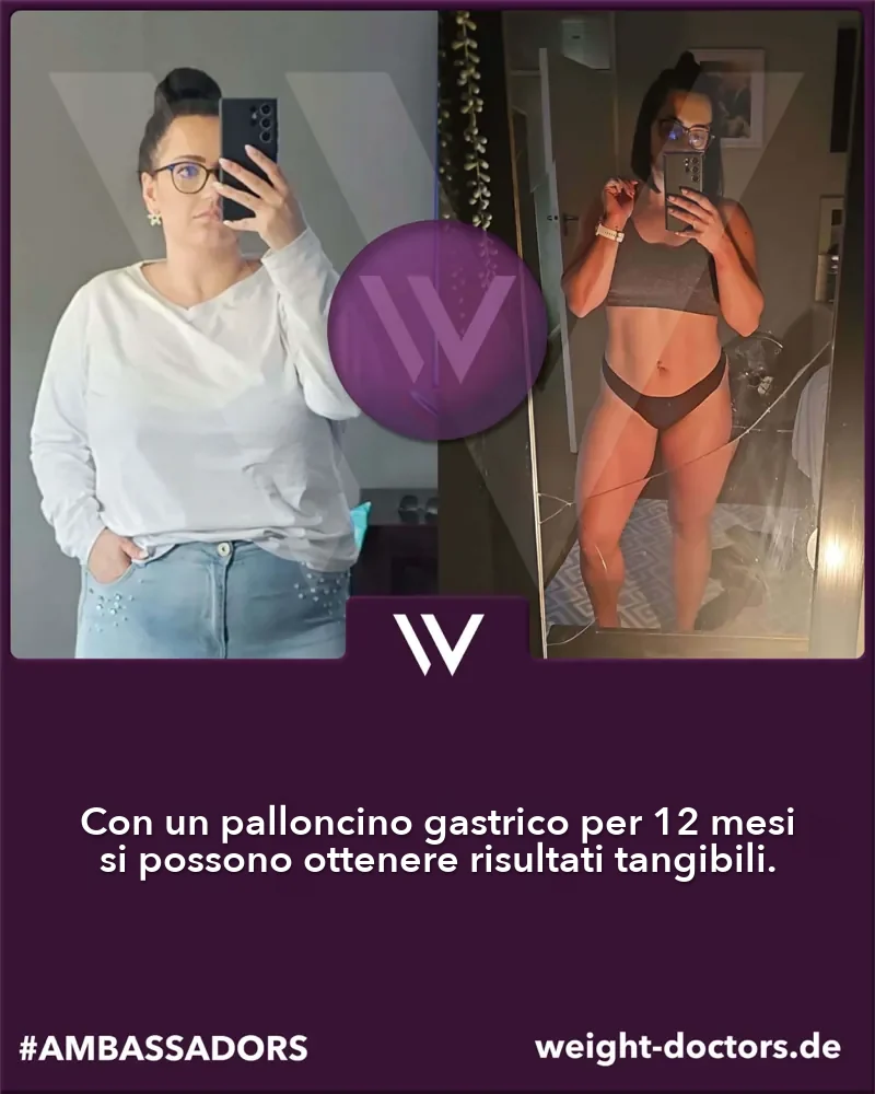 Weight Doctors® prima e dopo: paziente prima e dopo dodici mesi con Weight Doctors® PALLONCINO GASTRICO