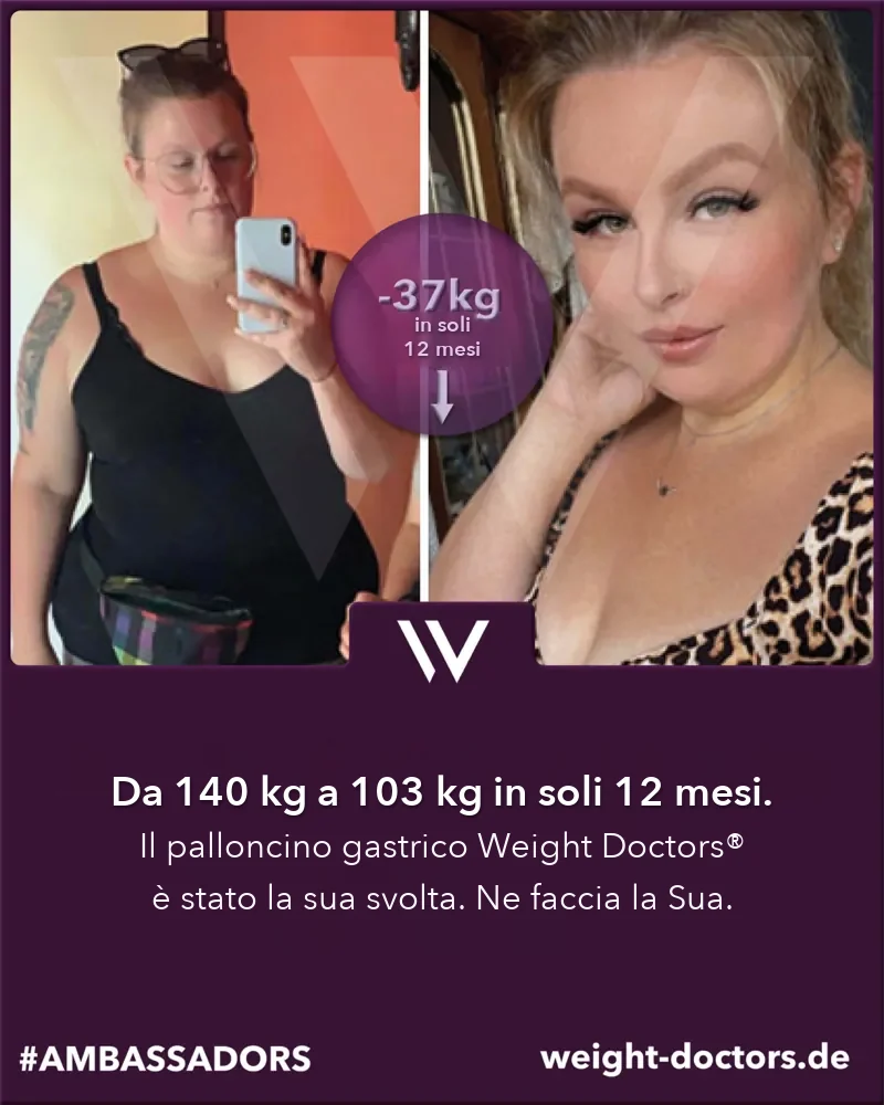 Weight Doctors® prima e dopo: paziente da 140 kg a 103 kg in dodici mesi, con il Weight Doctors® PALLONCINO GASTRICO