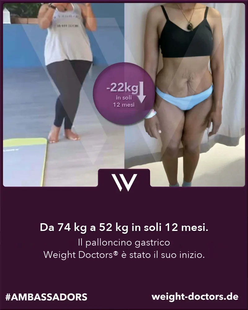 Weight Doctors® prima e dopo: paziente da 74 kg a 52 kg in dodici mesi, con il Weight Doctors® PALLONCINO GASTRICO