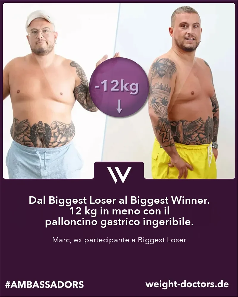 Weight Doctors® prima e dopo: Marc, ex partecipante a «The Biggest Loser», 12 kg in meno con il palloncino gastrico Allurion
