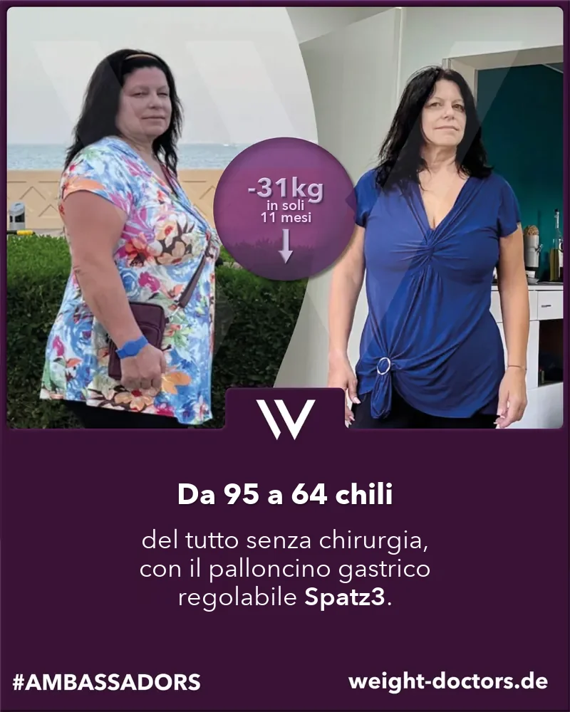 Weight Doctors® prima e dopo: paziente da 95 a 64 chili del tutto senza intervento chirurgico, con il palloncino gastrico regolabile Spatz3