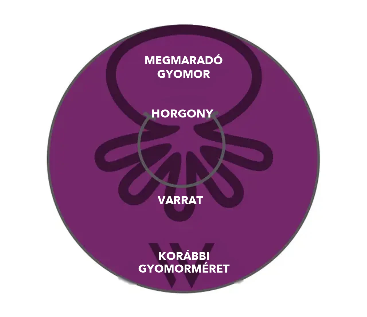 Az OverStitch NXT™ ábrája: horgony és varrat redőzi össze a gyomorfalat, a megmaradó gyomor jelentősen kisebb a korábbi gyomorméretnél