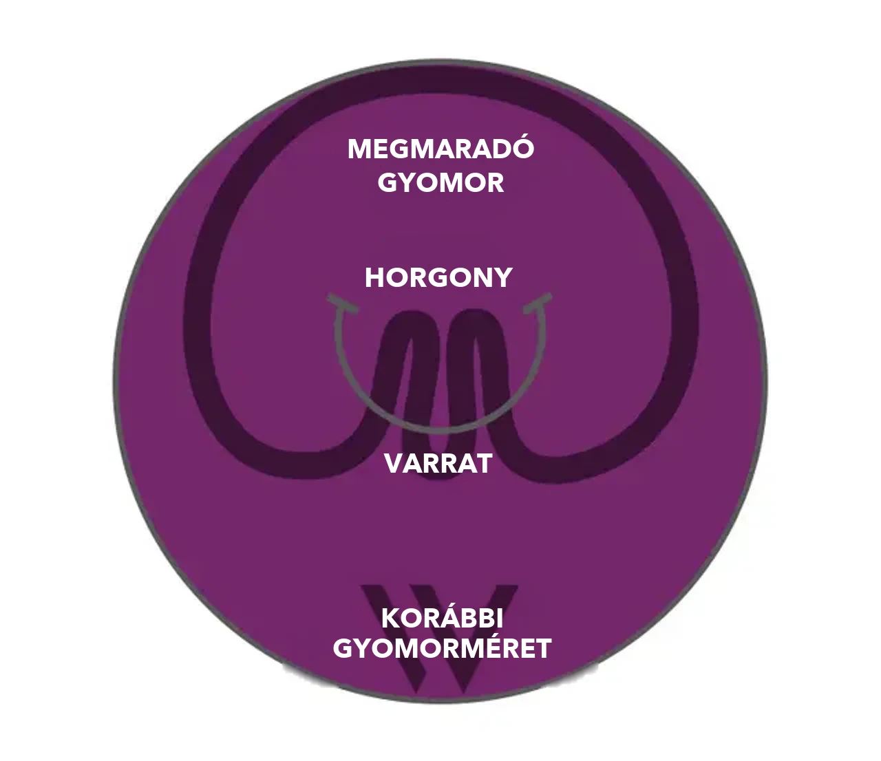 A pose® 3.0 Double Helix ábrája: horgony és varrat redőzi a gyomorfalat, a megmaradó gyomor jelentősen kisebb a korábbi gyomorméretnél
