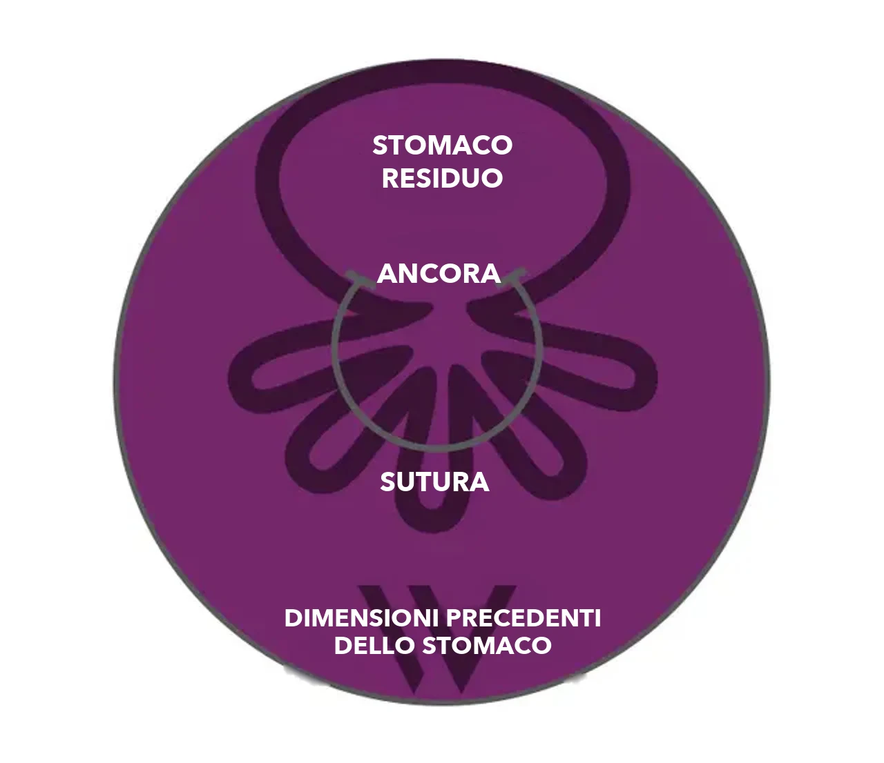 Schema OverStitch NXT™: ancore e sutura raccolgono la parete dello stomaco, lo stomaco rimanente è nettamente più piccolo delle dimensioni precedenti
