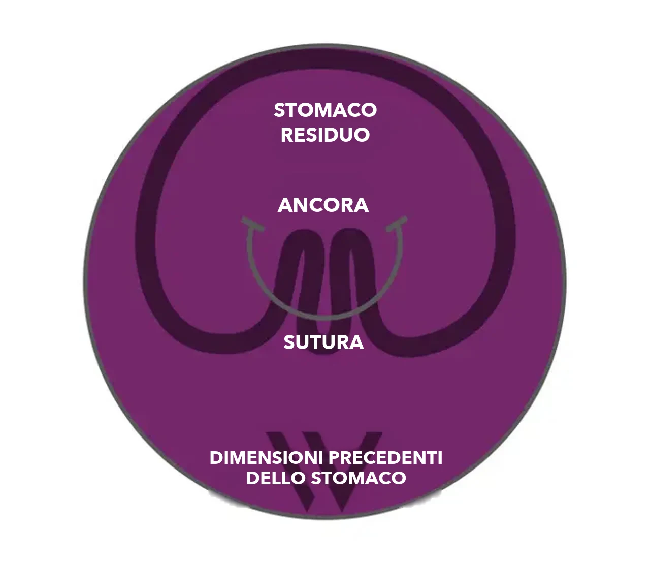 Disegno schematico: stomaco dopo la plicatura con pose® 3.0 Double Helix – stomaco residuo, ancoraggi e sutura all’interno delle dimensioni precedenti dello stomaco