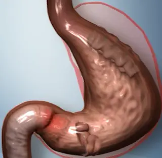 Stomaco dopo la procedura pose® con pieghe nella parte superiore e prima dell’uscita dello stomaco, con le dimensioni precedenti contornate in rosso