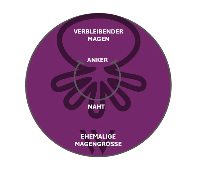 Schema OverStitch NXT™: Anker und Naht raffed d Magewand, de verblibend Mage isch dütlich chliiner als di ehemalig Magegrössi