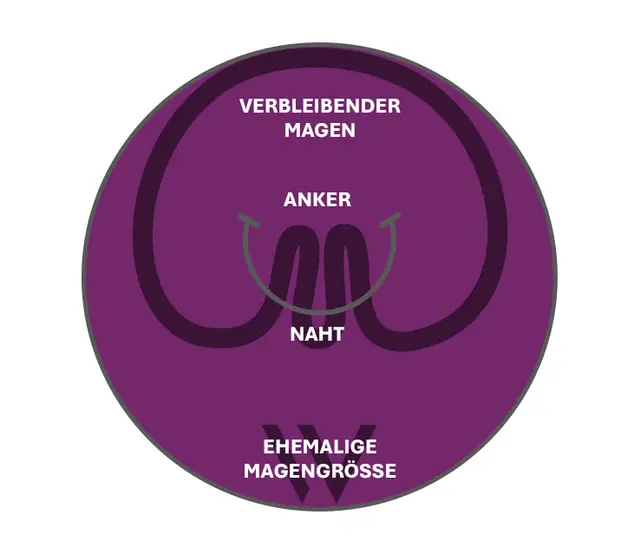 Schema pose® 3.0 Double Helix: Anker und Naht falted d Magewand, de verblibend Mage isch dütlich chliiner als di ehemalig Magegrössi
