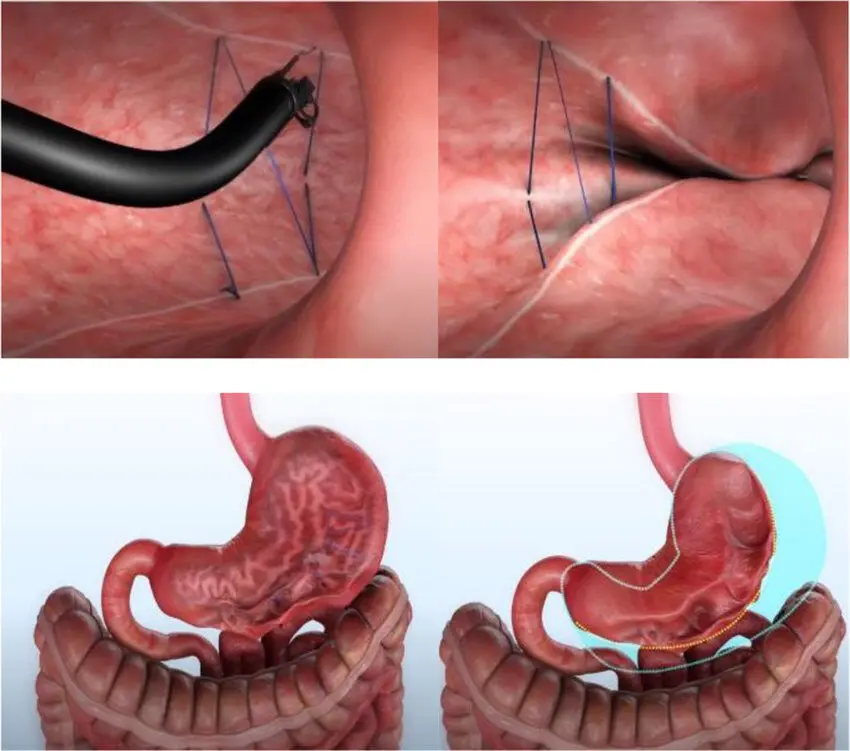 Sutura endoscopica con OverStitch NXT™: in alto l’endoscopio che sutura la parete gastrica, in basso lo stomaco prima e dopo con le dimensioni precedenti evidenziate